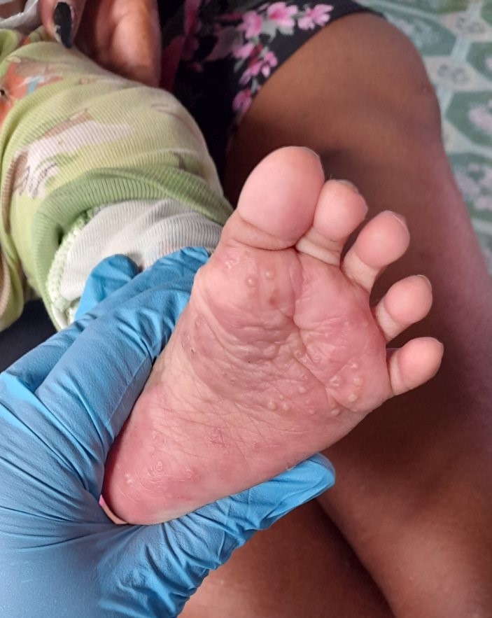 A 6 month old baby found with scabies by a survey skin examiner in the Western Division of Fiji, 2021 World Scabies Program