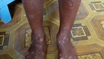 The Solomon Islands launches Mass Drug Administration Campaign Against Scabies and Yaws